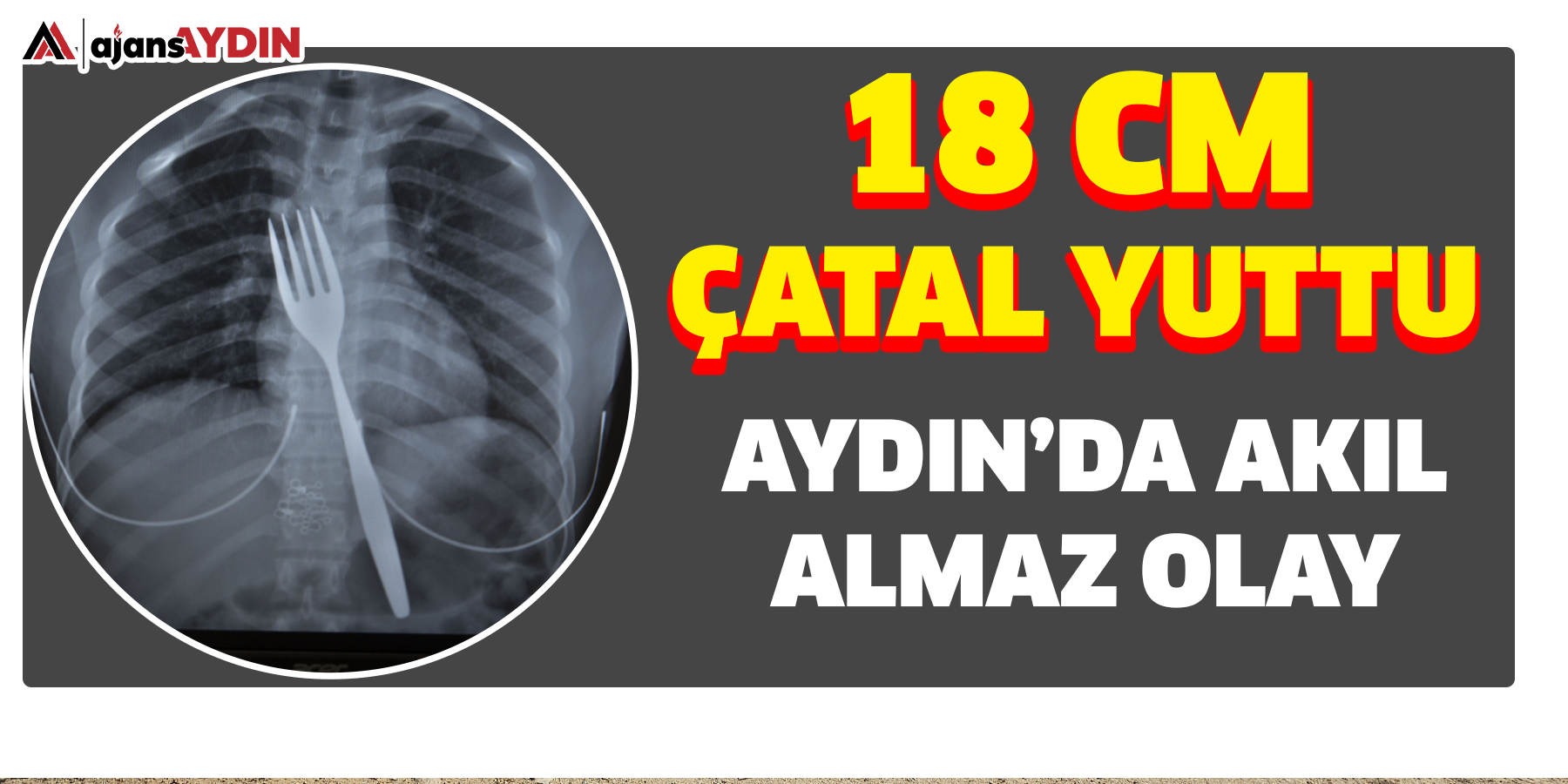 Aydın’da akıl almaz olay: 18 cm Çatal yuttu